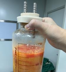 遂宁水动力吸脂手术要做多久？